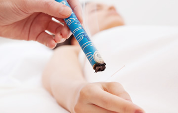 Moxibustion